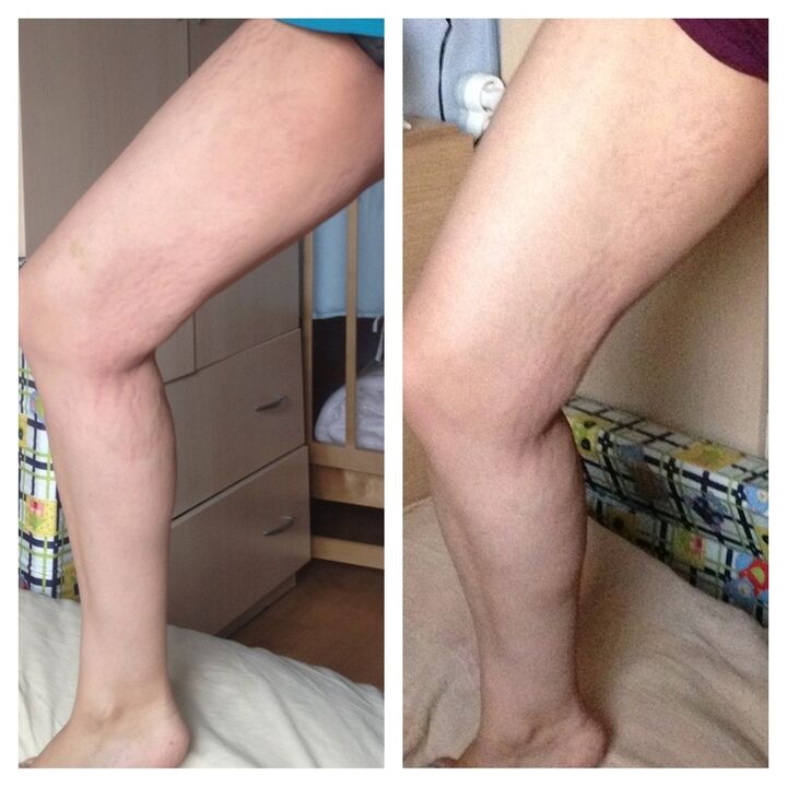 Knees before and after